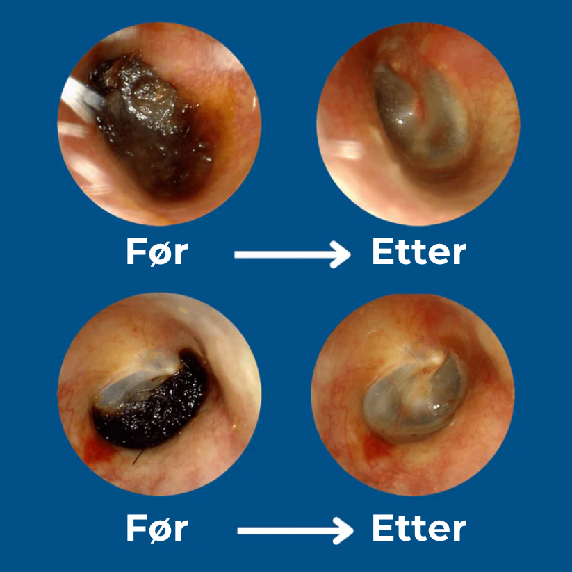 EarEase™ | Smart visuelt ørerense-sett