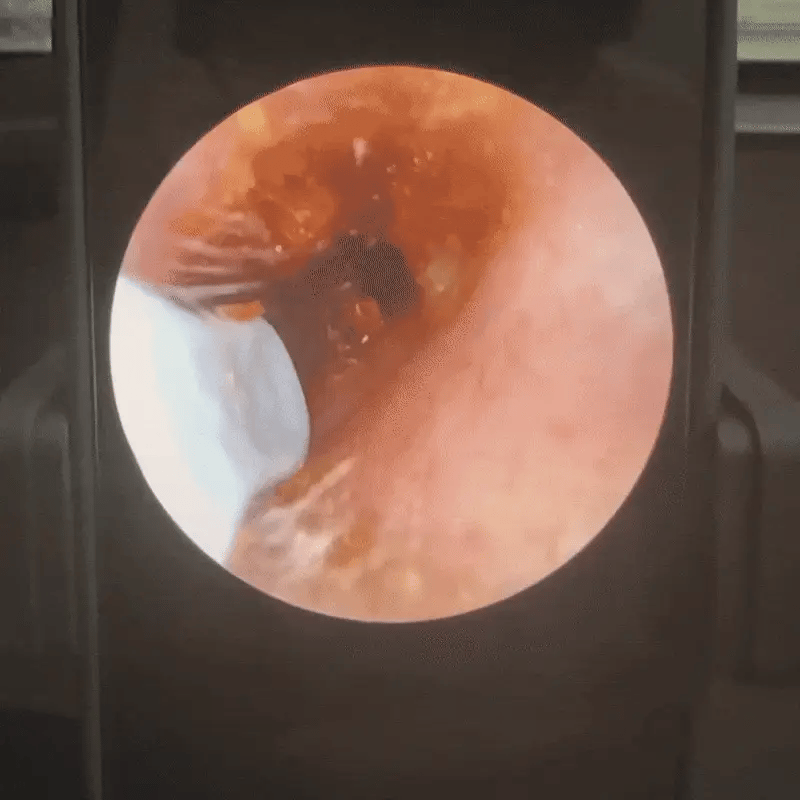 EarEase™ | Smart visuelt ørerense-sett