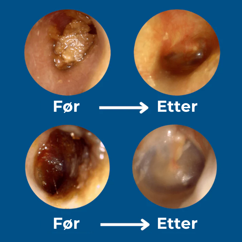 EarEase™ | Smart visuelt ørerense-sett