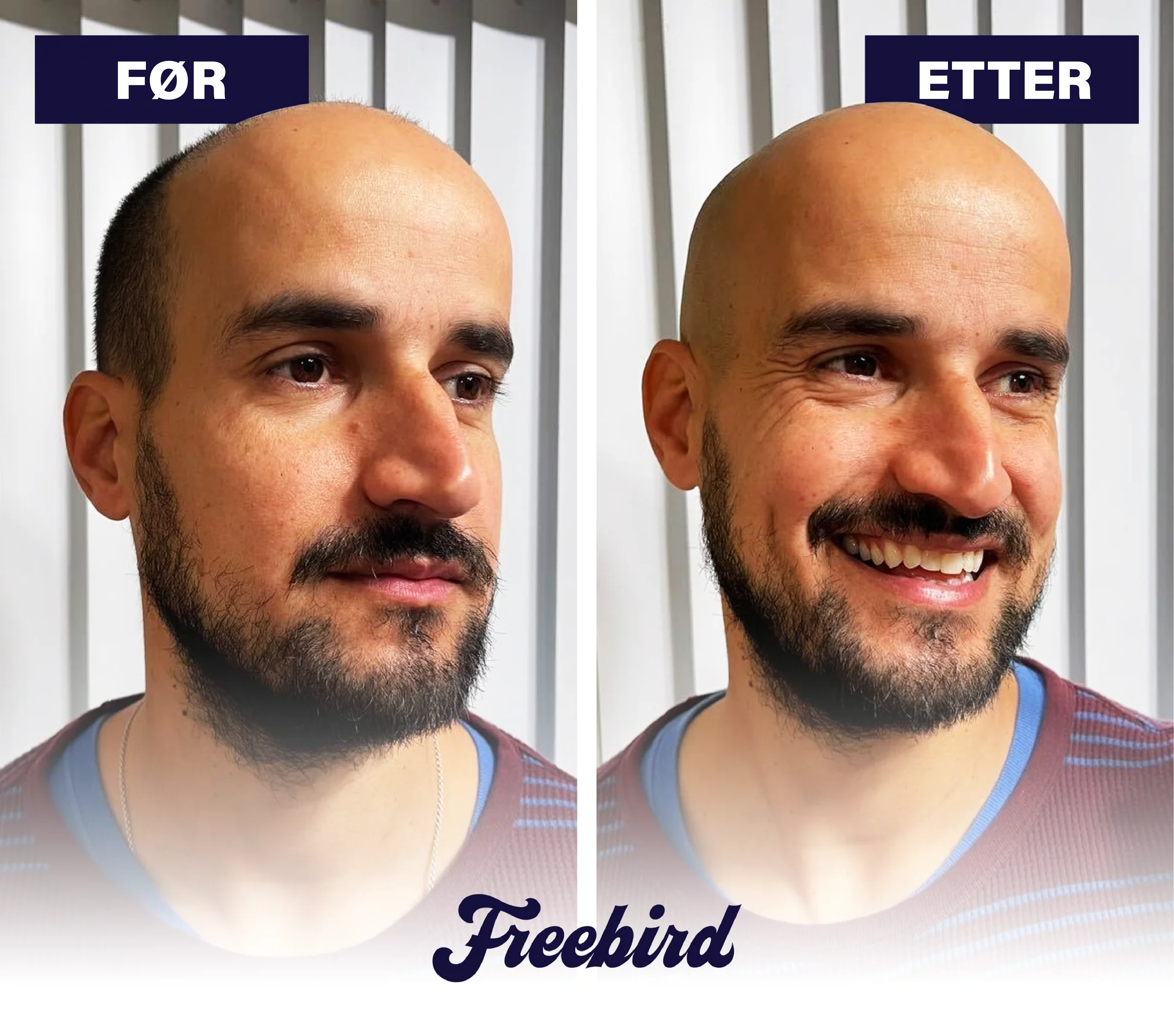 FlexSeries® Pro: Hodebarbering alt-i-ett sett